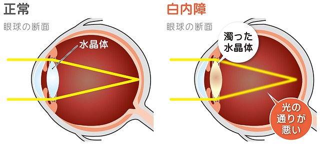 白内障手術のやり方