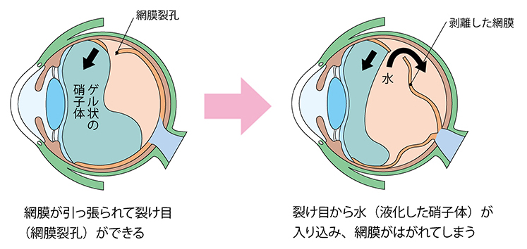 網膜裂孔・網膜剥離とは