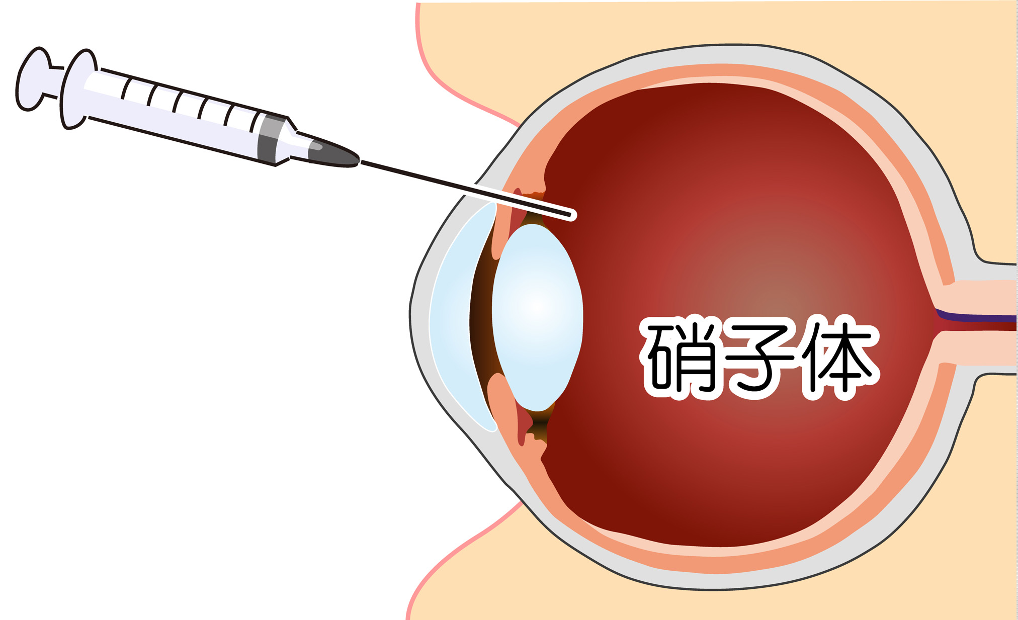 硝子体注射（抗VEGF療法）とは