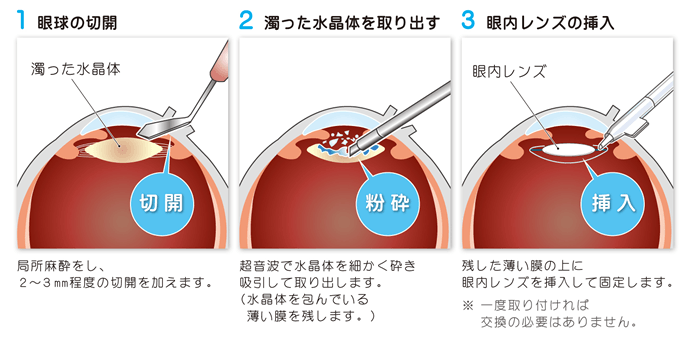 白内障手術のやり方