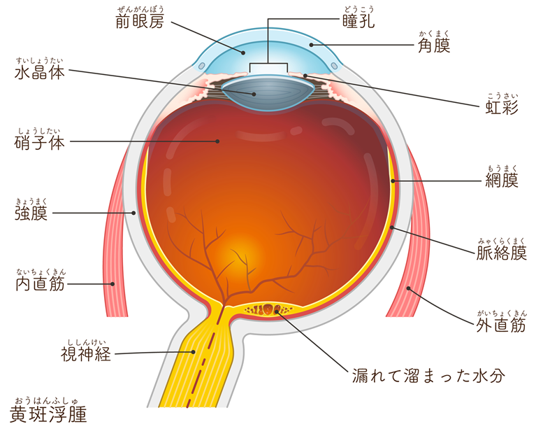 黄斑浮腫とは