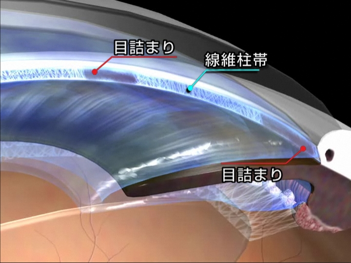 原発開放隅角緑内障