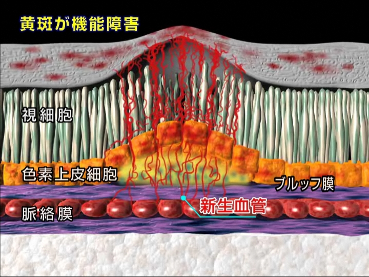 滲出型加齢黄斑変性