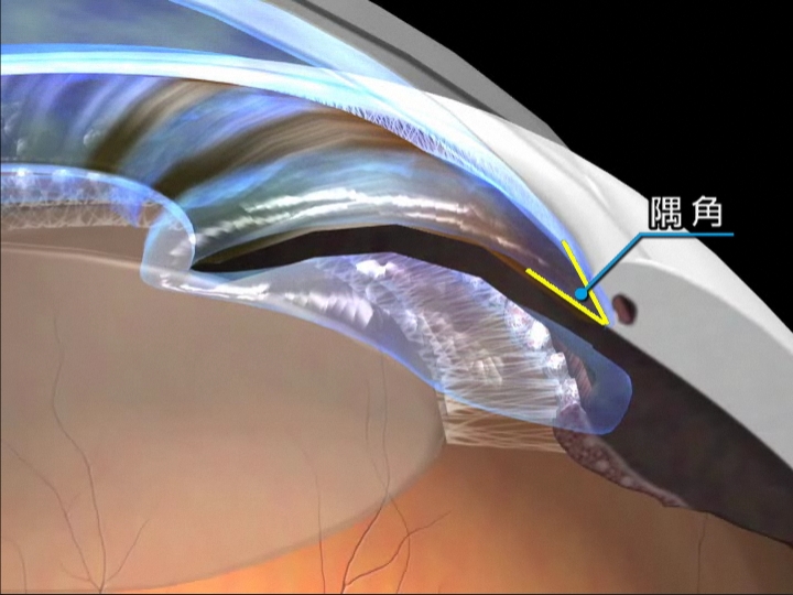原発閉塞隅角緑内障