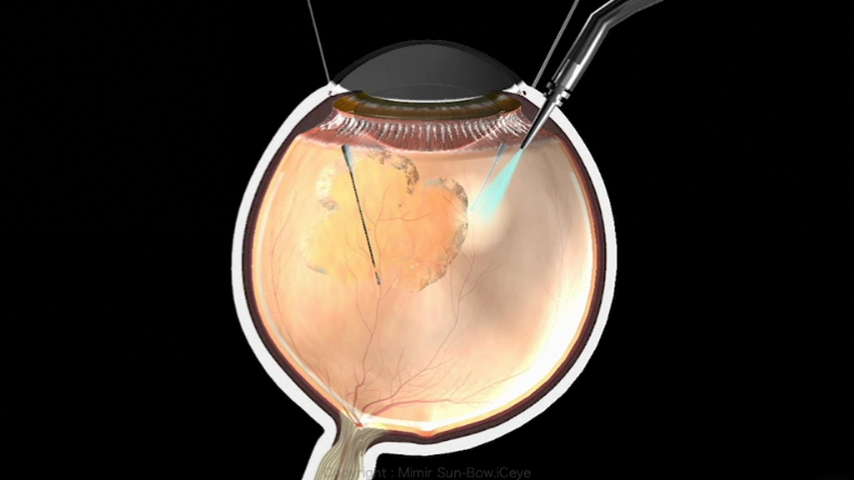 硝子体手術のやり方