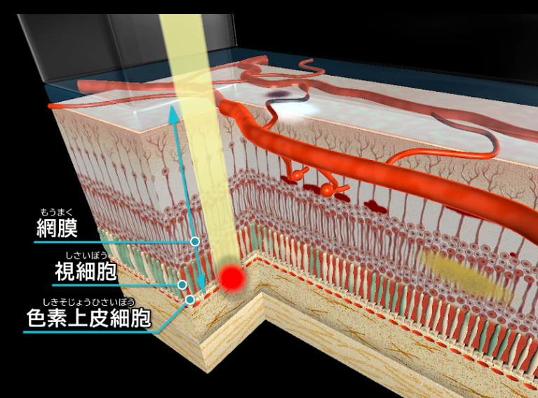 レーザー光凝固